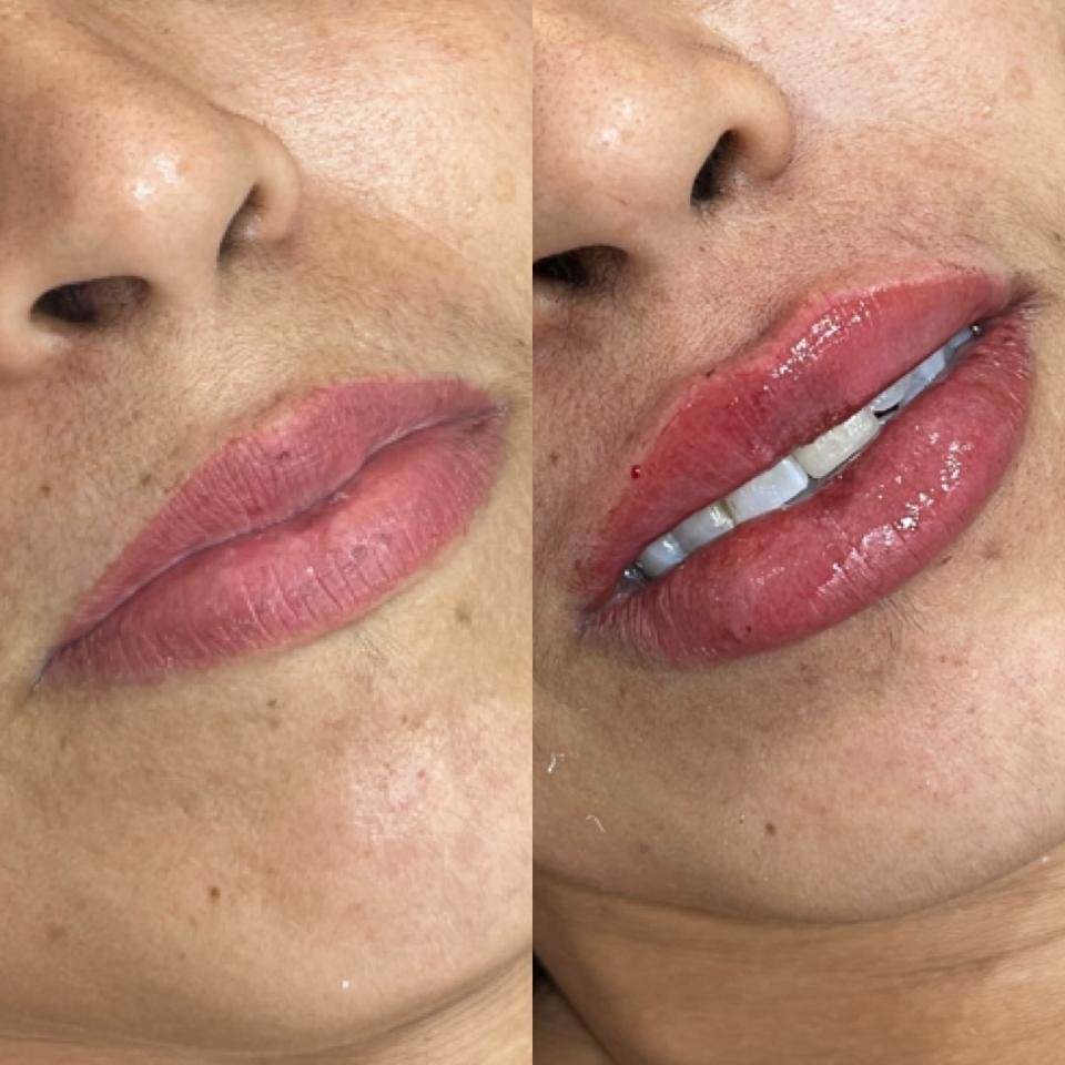 Preenchimento labial: mais beleza e autoestima em alta